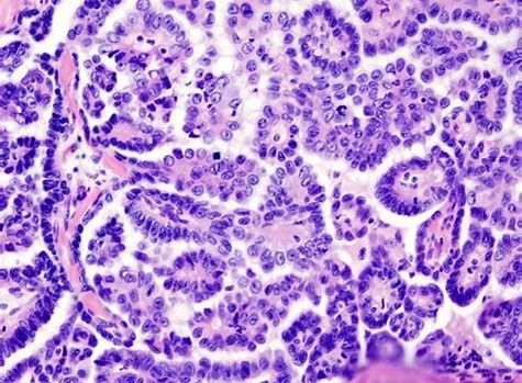 CancerRes：新研究发现帮助清除癌症干细胞的新靶标